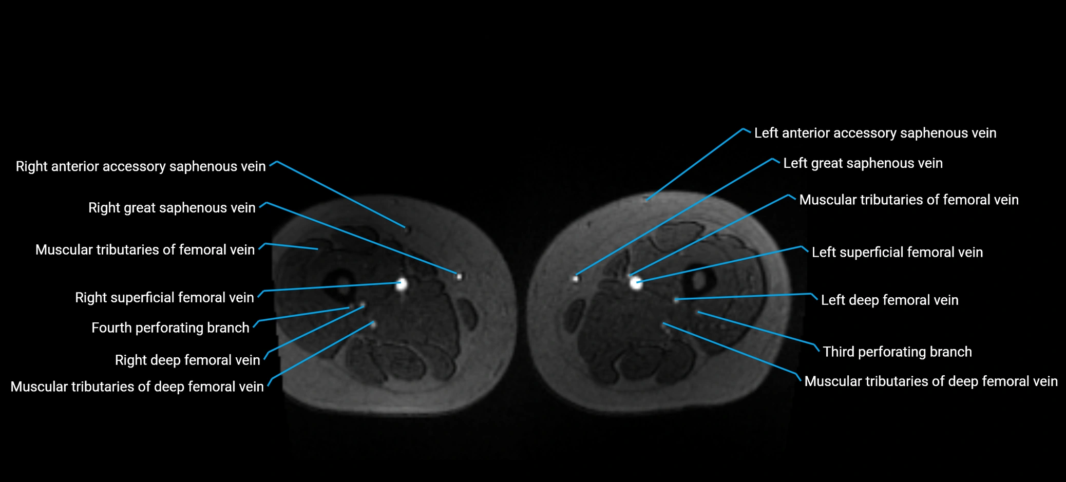 MRV abdomen pelvis & lower limb axial cross sectional anatomy labelled MRI image 267 (1).webp